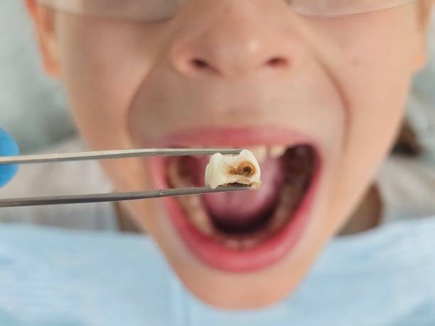 Best Emergency Treatment for Toothache in Amsterdam, NY